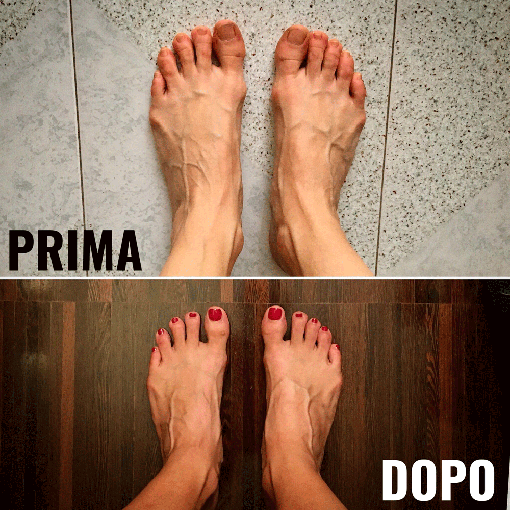 piedi prima e dopo